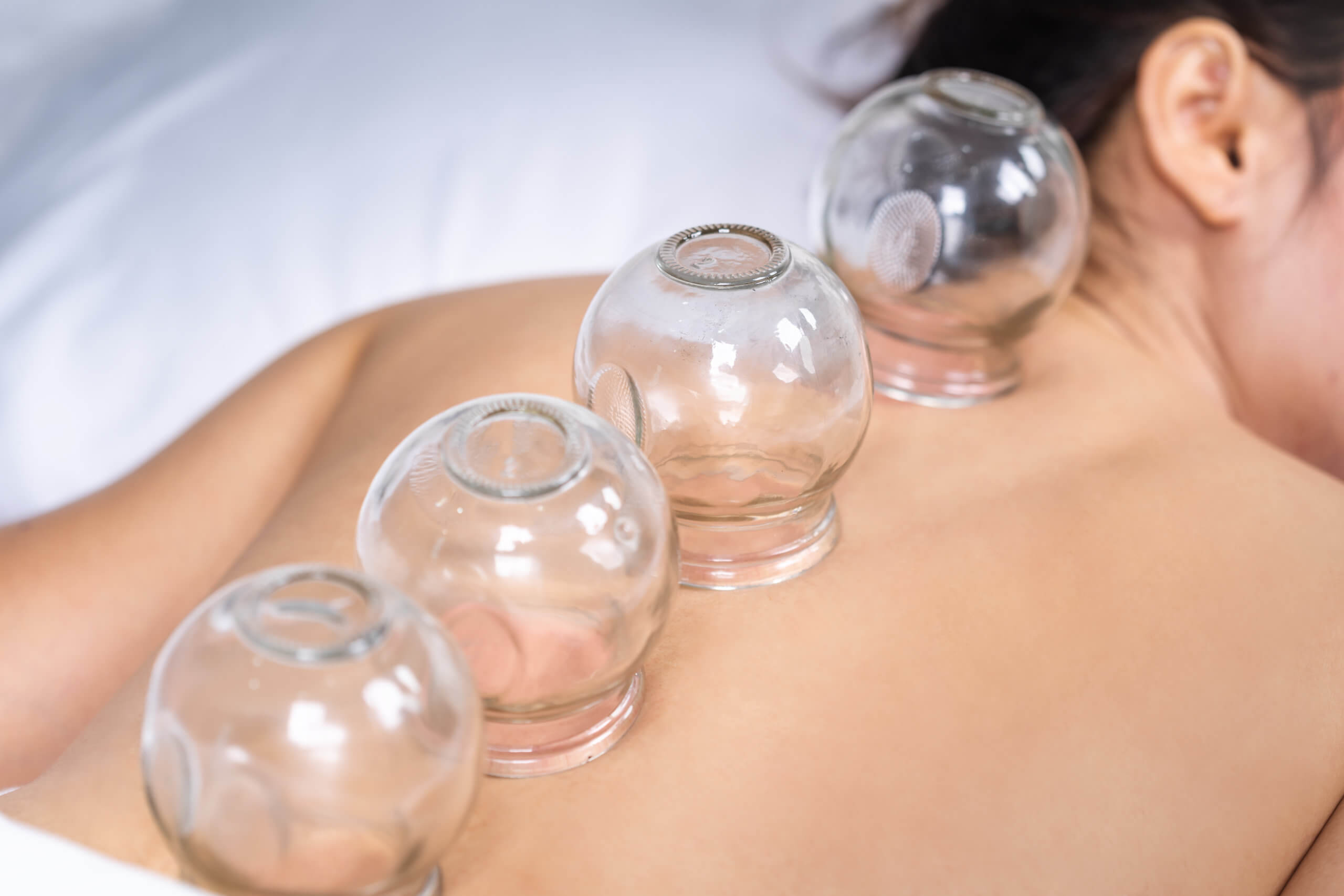 cupping-therapy-scaled